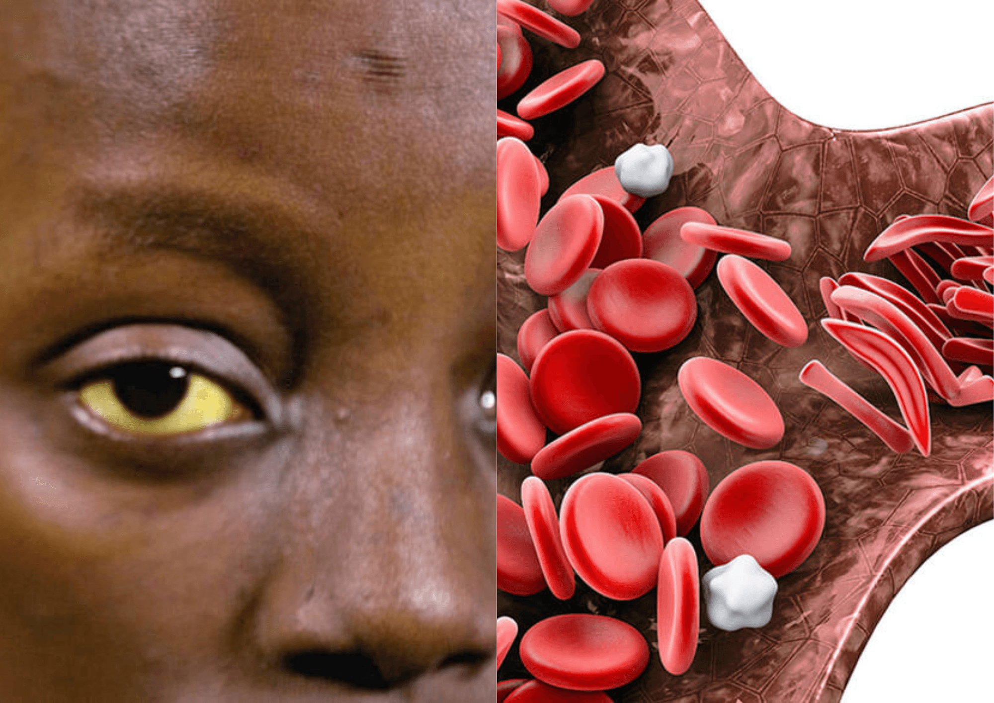 Beyond September: why sickle cell awareness should not be seasonal
